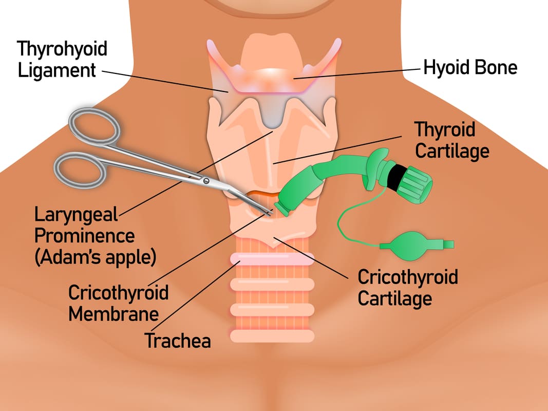 Cricothyrotomy Procedure Diagram
