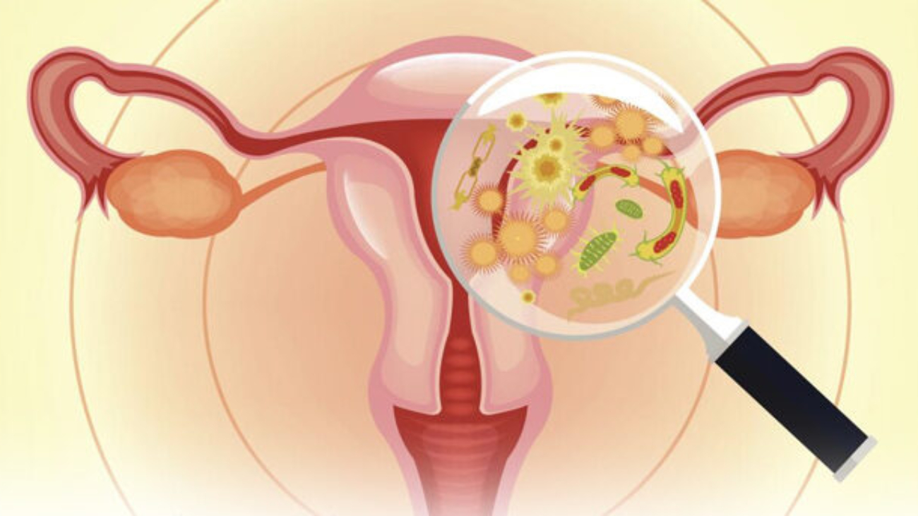 Genital Tract Infections (GTIs)