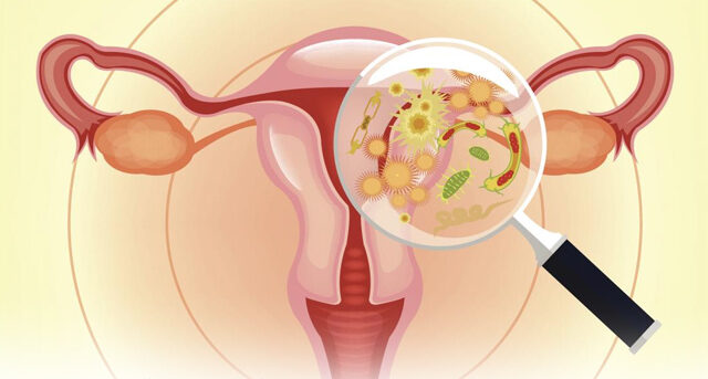 Genital Tract Infections (GTIs)