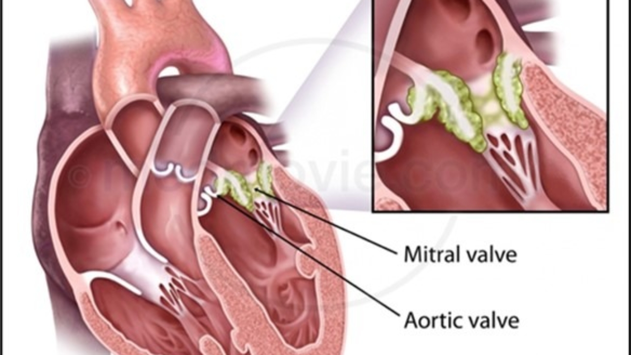 Infective Endocarditis (IE)