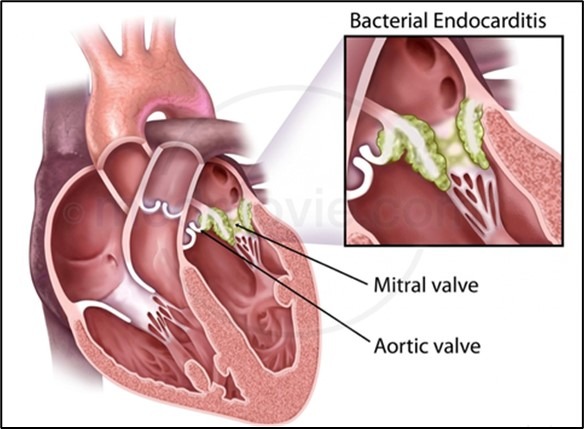 Infective Endocarditis (IE)