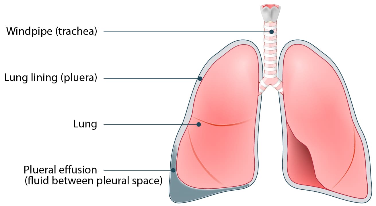Illustration of a right-sided pleural effusion with absent breath sounds and trachea displaced to the left