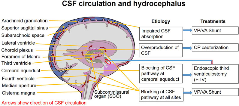 Figure 6: Congenital Hydrocephalus & CSF Circulation Pathway
