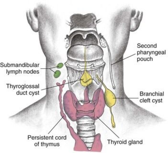 Diagram distinguishing a lateral Branchial Cleft Cyst from a midline Thyroglossal Duct Cyst