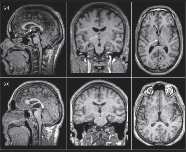 MRI scans showing axial, coronal, and sagittal views of normal and enlarged ventricles