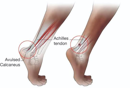 Figure 5.6A: Achilles Tendon Rupture — Complete tear with retraction