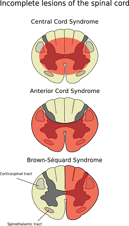 Figure 26: Anterior cord syndrome — damaged (red) vs. spared (gray) areas in spinal cord cross section