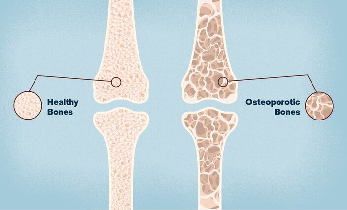 Bone disorders