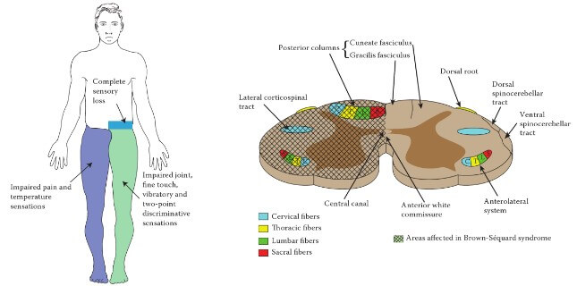 Figure 21: Brown-Séquard syndrome — affected tracts and body map