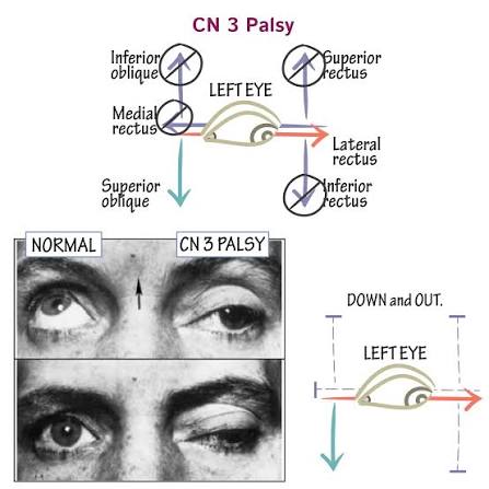 Figure 9 & 10: CN III palsy showing the affected eye 'down and out' with ptosis and dilated pupil