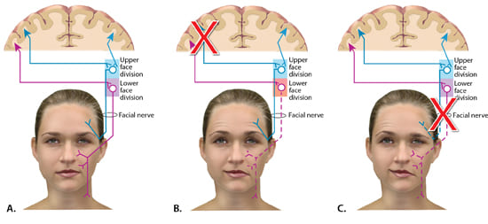 Figure 20 & 21: Central (UMN) vs Peripheral (LMN) facial palsy comparison