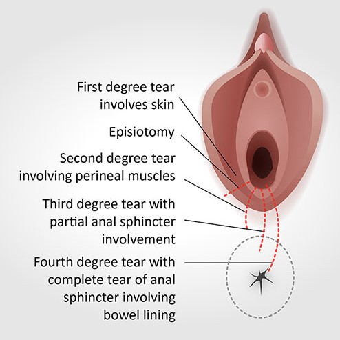 Figure 6.1 - Classification of perineal tears from 1st to 4th degree, showing the structures involved at each level