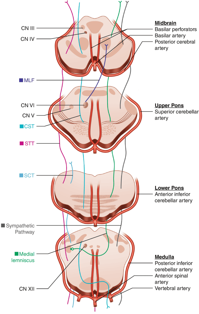 Diagram: Cross sections of the midbrain, pons, and medulla showing medial and lateral vascular territories