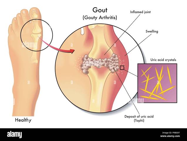 Figure 5.3C: Gout — Uric acid crystal deposition in the first MTP joint with tophus formation