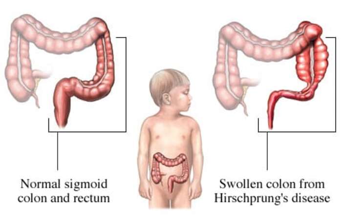 Figure 13: Hirschsprung disease in infant — swollen colon proximal to aganglionic segment