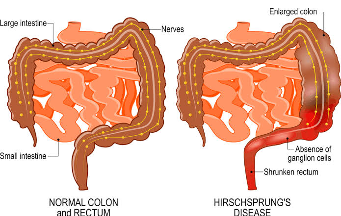 Figure 12: Hirschsprung disease — normal colon vs. aganglionic megacolon with absence of ganglion cells