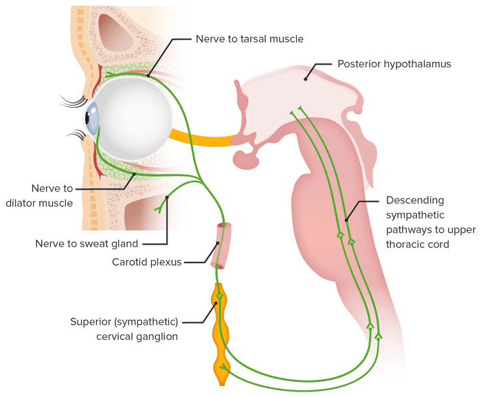 Figure 16: Horner's syndrome pathway — three-neuron chain from hypothalamus to superior cervical ganglion