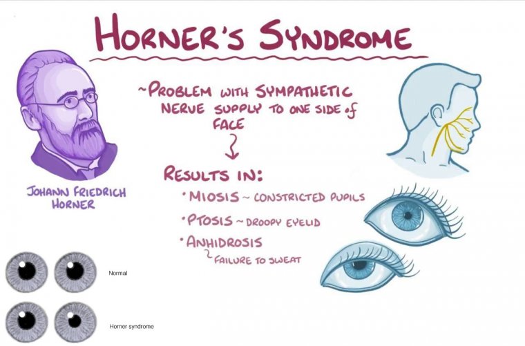 Figure 15: Horner's syndrome — ptosis, miosis, and anhidrosis with cervical sympathetic pathway