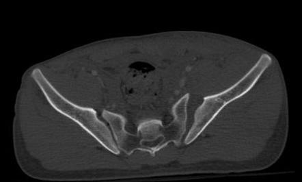 Illustration of open-book pelvic fracture with radiographic correlation