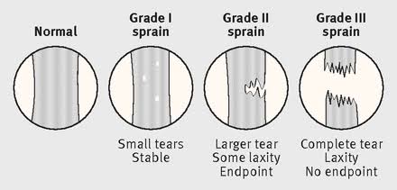 Figure 5.4A: Ligament Sprain Grades I-III