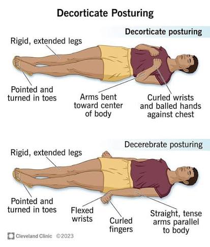 Figure 6.1 — Normal control vs. decerebrate posturing: loss of cortical inhibition over the pontine tract