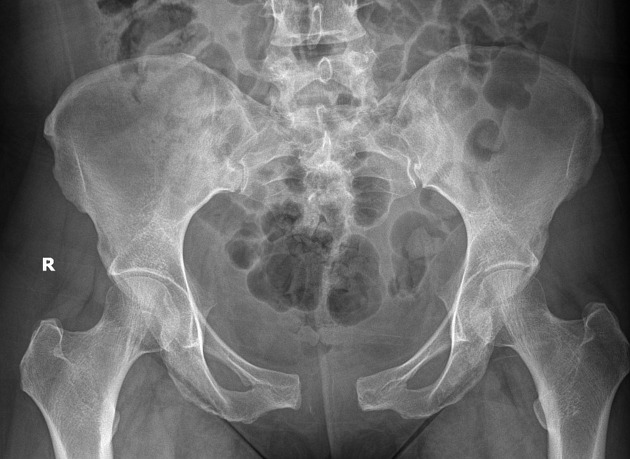 Open-book pelvic fracture showing external rotation of the hemipelvis