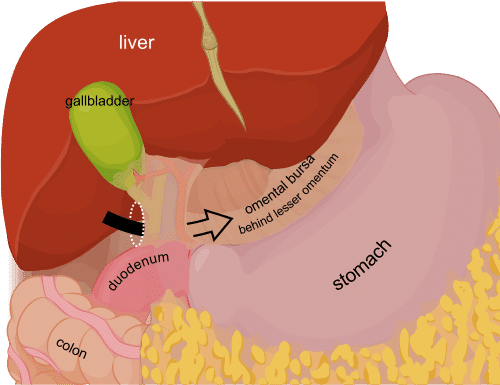 Figure 4.1: Peritoneal Cavity — Sagittal View — Greater sac, lesser sac (omental bursa), and relationships between liver, stomach, pancreas, and duodenum