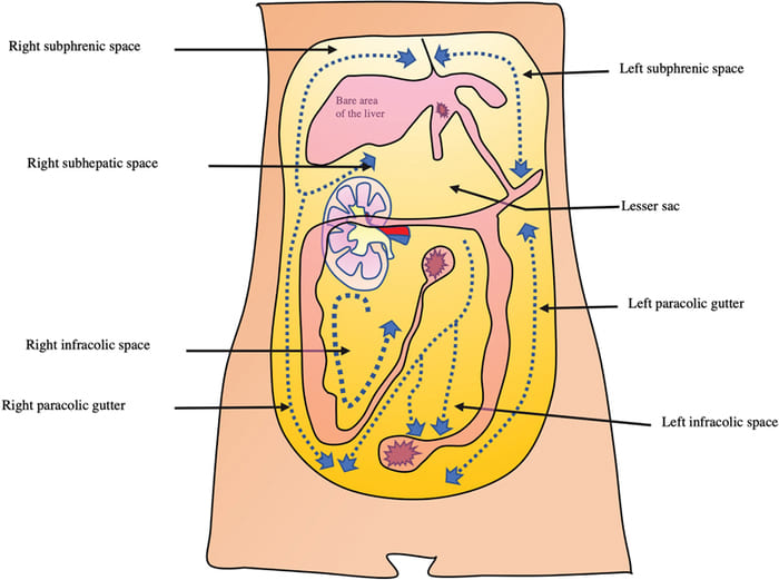 Figure 5.1: Peritoneal Spaces — Subphrenic and Subhepatic — Sagittal sections around the liver showing subphrenic spaces, lesser sac, and bare area