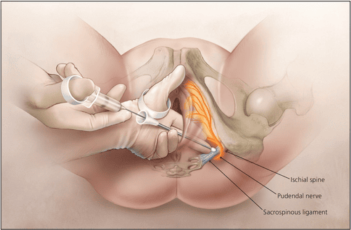 Posterior approach for pudendal nerve block showing needle placement relative to the ischial spine