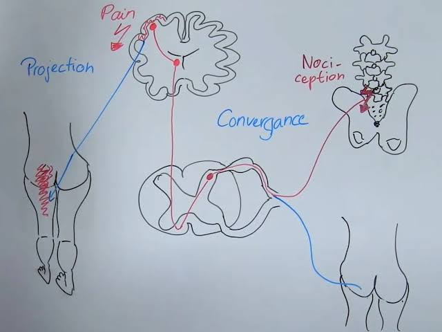Figure 7: Referred pain mechanism — convergence of visceral and somatic afferents in dorsal horn