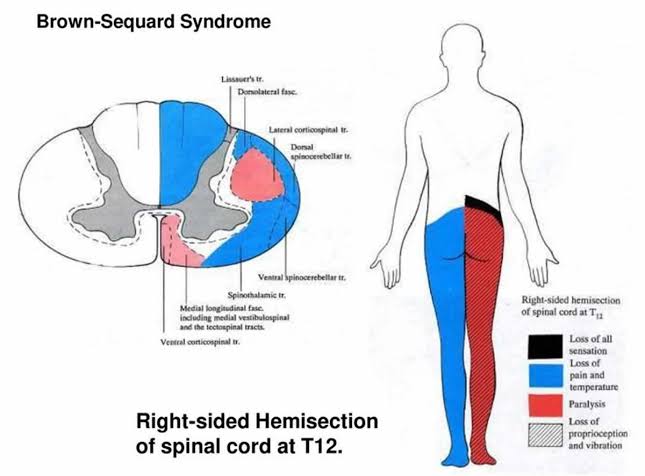 Figure 22: Right-sided hemisection at T12 with color-coded deficits