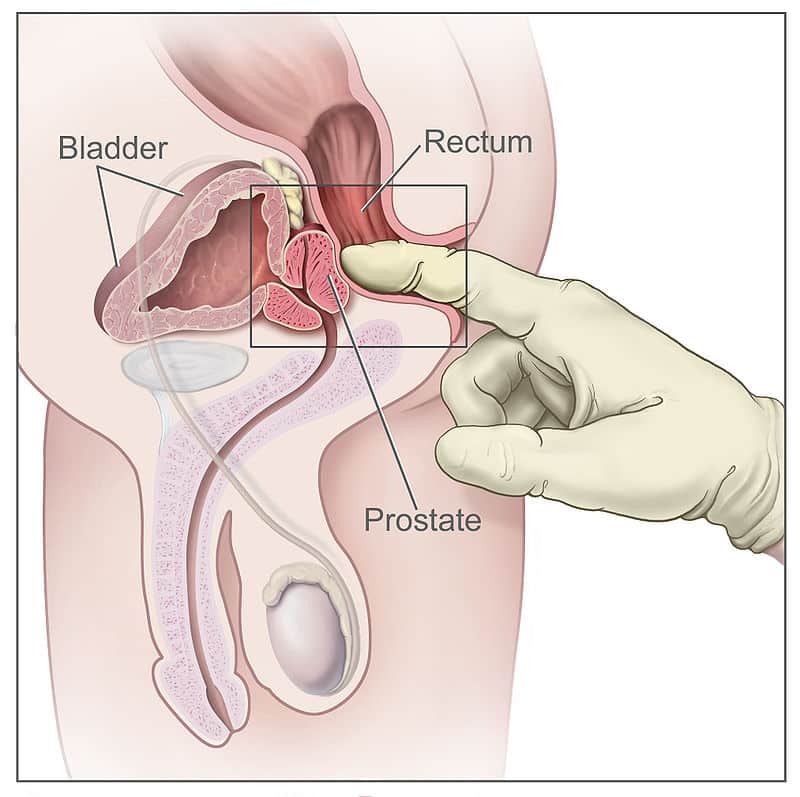 Figure 3.1 - Sagittal view showing the prostate gland in relation to the bladder, rectum, and urethra, demonstrating digital rectal examination (DRE) access