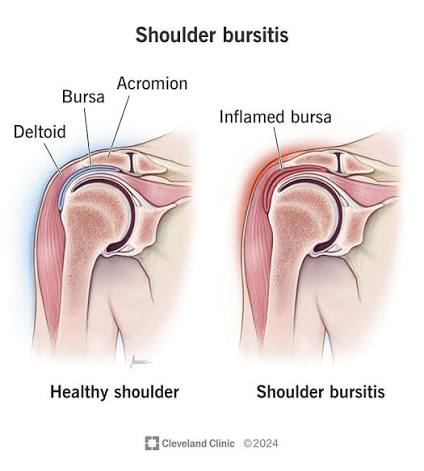 Figure 5.2A: Shoulder Bursitis — Comparison of healthy shoulder vs. inflamed subacromial bursa