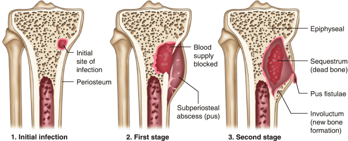 Figure 4: Stages of osteomyelitis development — sequestrum (dead bone) and involucrum (new bone formation)