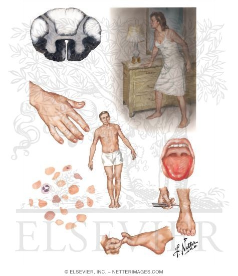 Figure 5: Subacute combined degeneration — Netter illustration showing dorsal column and lateral CST damage with clinical features