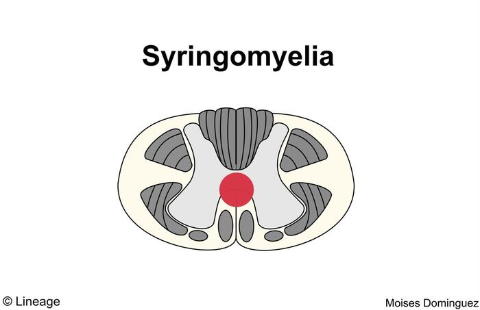 Figure 11: Syringomyelia cross section showing central cavitation