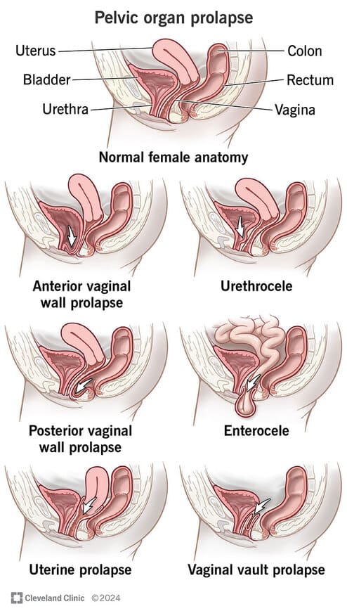 Types of pelvic organ prolapse: cystocele, rectocele, uterine prolapse, enterocele