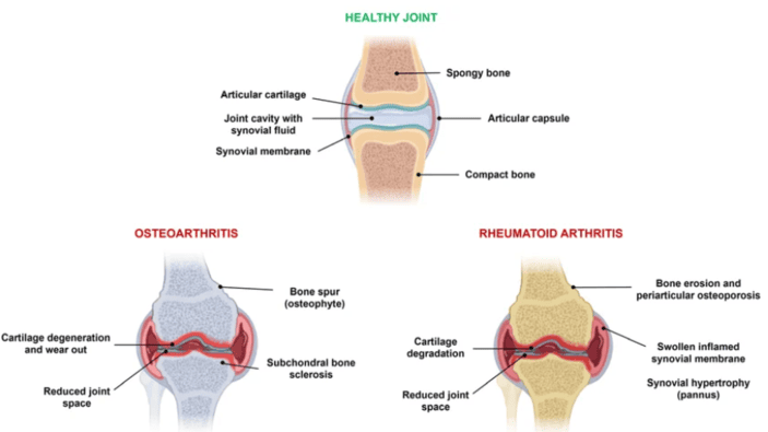 Figure 2: Comparison of a healthy joint, rheumatoid arthritis (inflammation), and osteoarthritis (cartilage degeneration)
