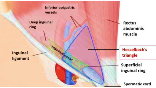 Figure 7.1: Hesselbach's triangle showing boundaries: rectus abdominis (medial), inferior epigastric vessels (lateral), and inguinal ligament (inferior)