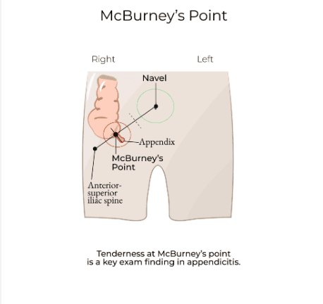 Figure 3.3: McBurney's Point landmark