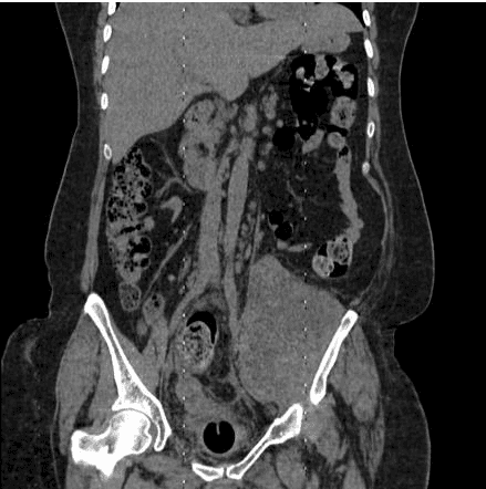 Figure: Coronal CT demonstrating a right psoas muscle abscess with surrounding inflammatory change. Note the relationship to the vertebral column and iliac vessels