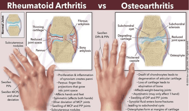 Figure 5.3A: Rheumatoid Arthritis vs. Osteoarthritis — Comparative anatomy and clinical features
