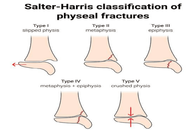 Figure 3.6 — Salter-Harris Classification of Physeal Fractures (Types I–V)