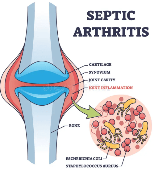 Figure 5.3B: Septic Arthritis — Joint inflammation with bacterial pathogens