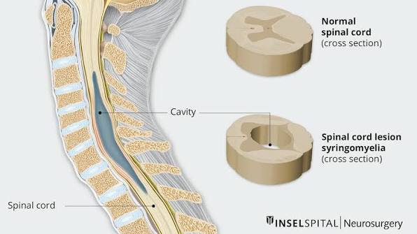 Figure 10: Syringomyelia — central cavity in spinal cord compressing anterior white commissure