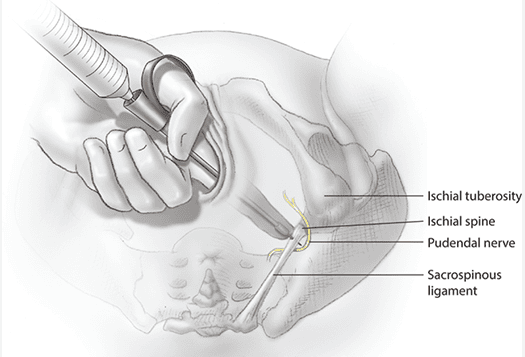 Figure 5.3 - Transvaginal approach for pudendal nerve block, showing the relationship between the ischial spine, pudendal nerve, and sacrospinous ligament