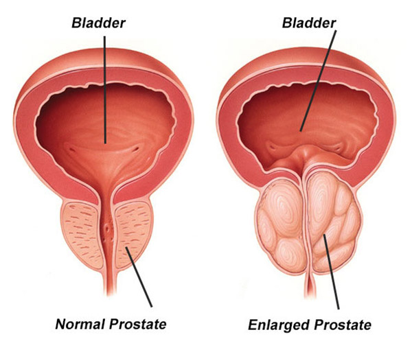 Figure 4. BPH showing normal prostate vs enlarged prostate compressing the urethra