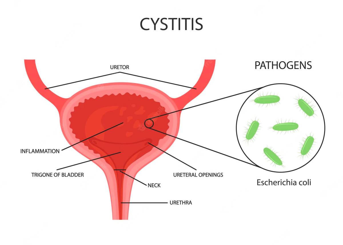 Figure 1. Bladder infection (cystitis) showing inflamed bladder mucosa with bacterial colonization