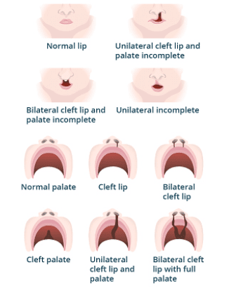 Figure 4. Classification of cleft lip and cleft palate including unilateral, bilateral, complete, and incomplete forms.