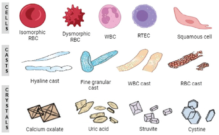 Figure 4: Common microscopic findings in urine sediment: RBCs, WBCs, Squamous/Renal Epithelium, Hyaline/RBC/WBC/Granular/Waxy Casts, and Crystals